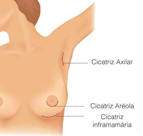 prótese-de-silicone-cicatriz