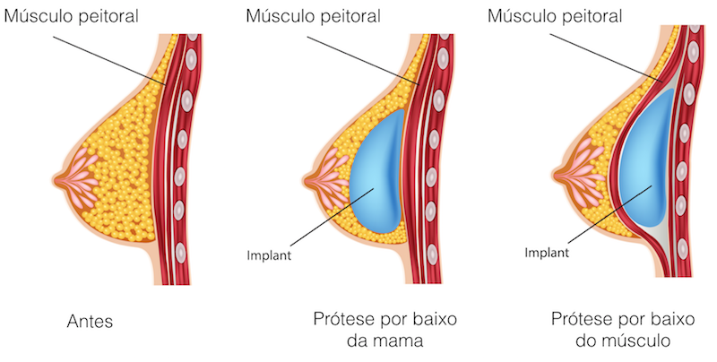 prótese de silicone músculo