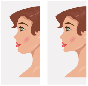 lifting facial ou cirurgia plástica do rosto 6