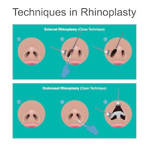 rinoplastia técnica aberta