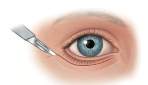 cirurgia de pálpebras 5 inferior