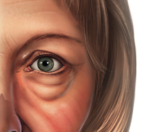 cirurgia de pálpebras 6 inferior