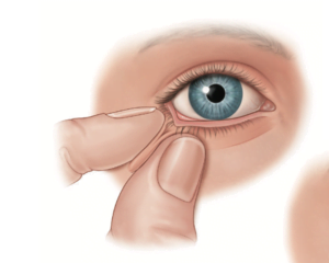 cirurgia de pálpebras 7