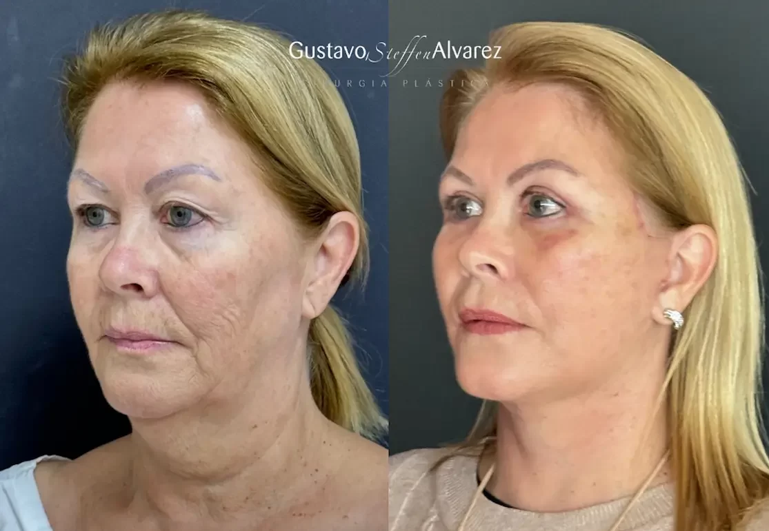 abertura-lifting-facial-deep-plane-dr-gustavo-alvarez